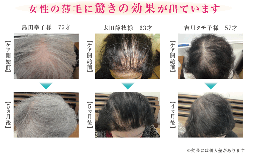 女性用育毛剤［CA101］の効果